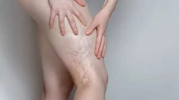 uzmanindan uyari ileri derecedeki varis hayati tehdit edebilir c3rJhR8R.jpg